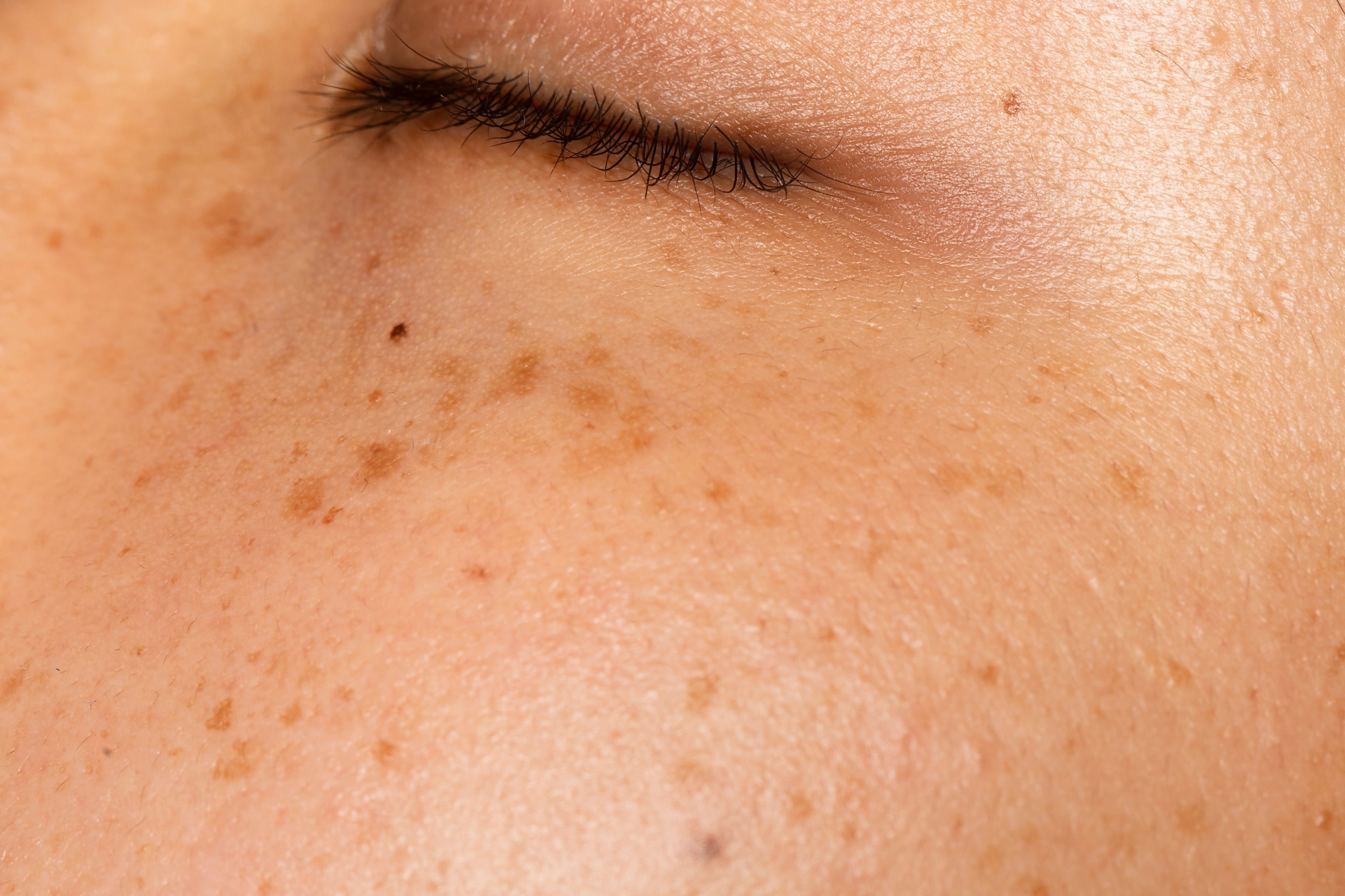 Can Vitamin C Really Fade Dark Spots?